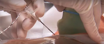 Ultrasound for Anesthesia