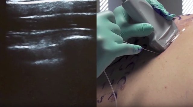 Log into Sonosite Institute today, and begin your ultrasound-guided paravertebral nerve block education with our new learning module Log into Sonosite Institute today, and begin your ultrasound-guided paravertebral nerve block education with our new learning module
