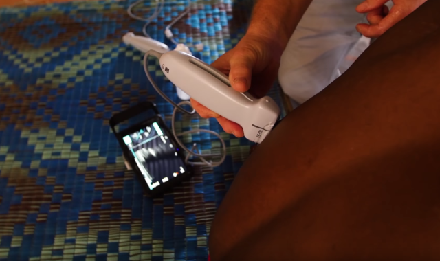 Sonosite handheld ultrasound for global health missions Sonosite handheld ultrasound for global health missions